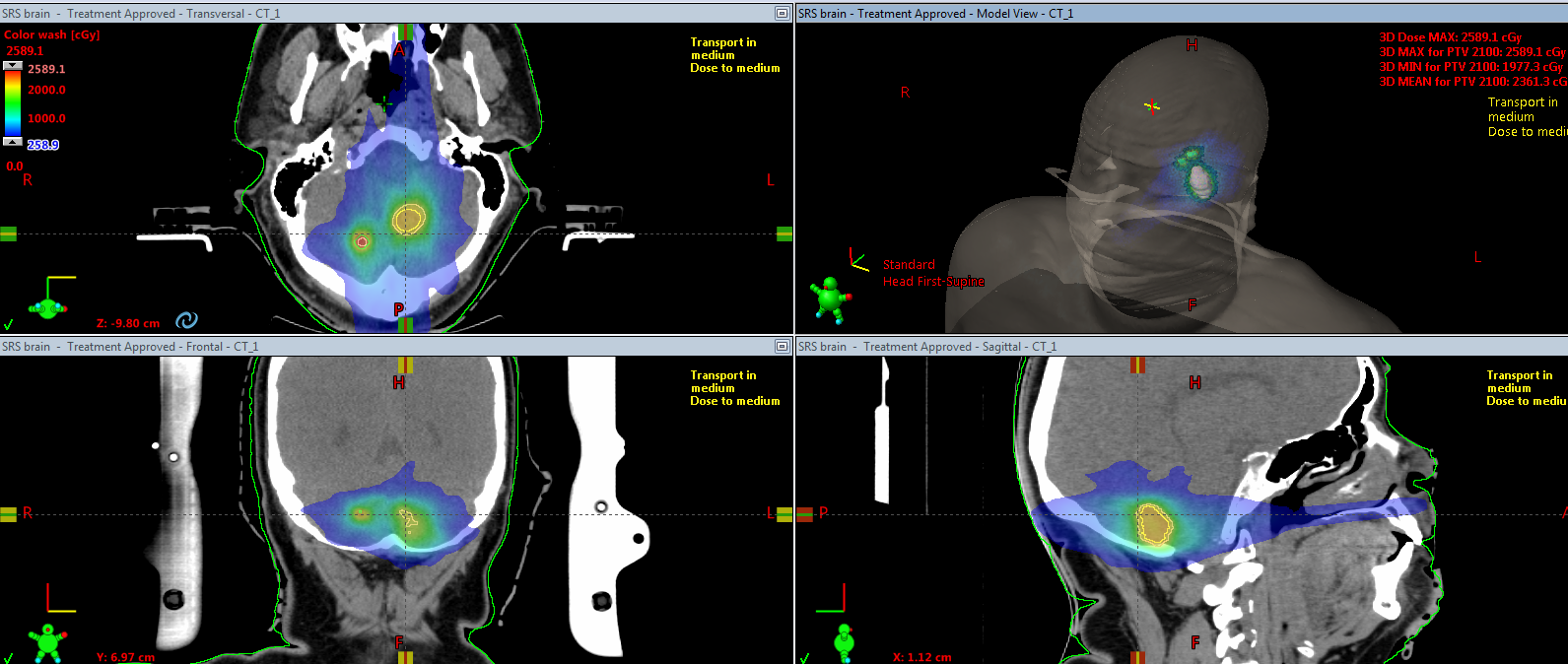 Gaining Greater Insights Into Stereotactic Treatments Without Losing Efficiency